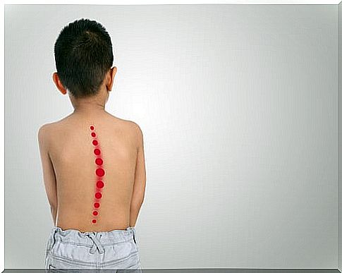 Child with scoliosis